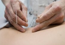 Kan akupunktur hjælpe os med at blive gravide?