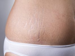 Kan jeg bruge aloe vera gel på maven for at “undgå” strækmærker? Jeg vil gerne høre om det er godt at bruge aloe vera gel på maven for at "undgå" strækmærker?